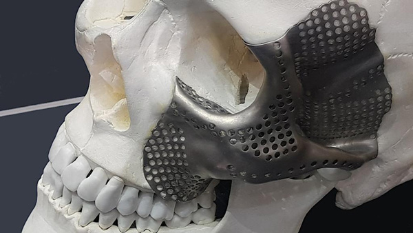 3D printing in medical